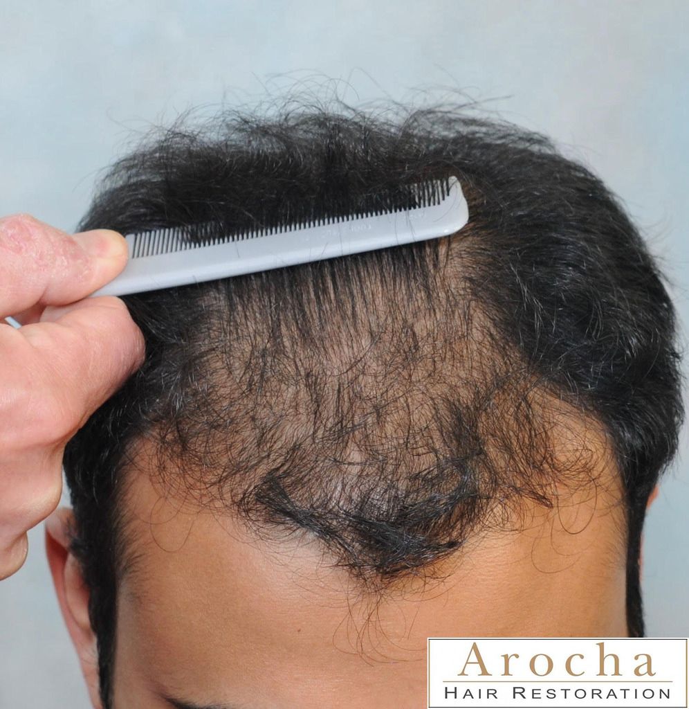 arocha-hair-transplant-texas-3_zpsgfqukejg.jpg