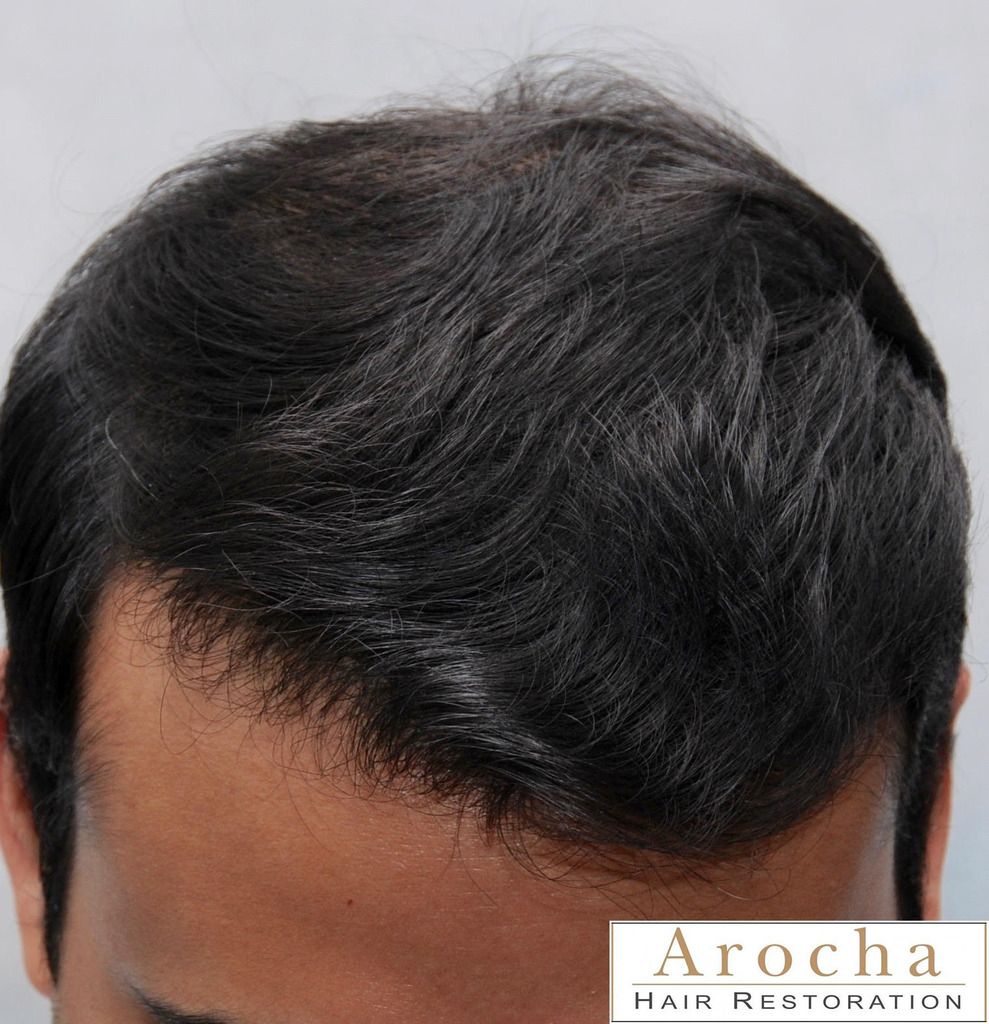 arocha-hair-transplant-texas-4_zps3zghgiz6.jpg