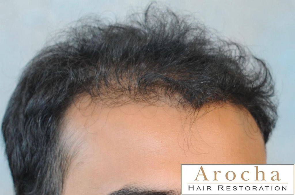 arocha-hair-transplant-texas-5_zpsfgy68tm8.jpg