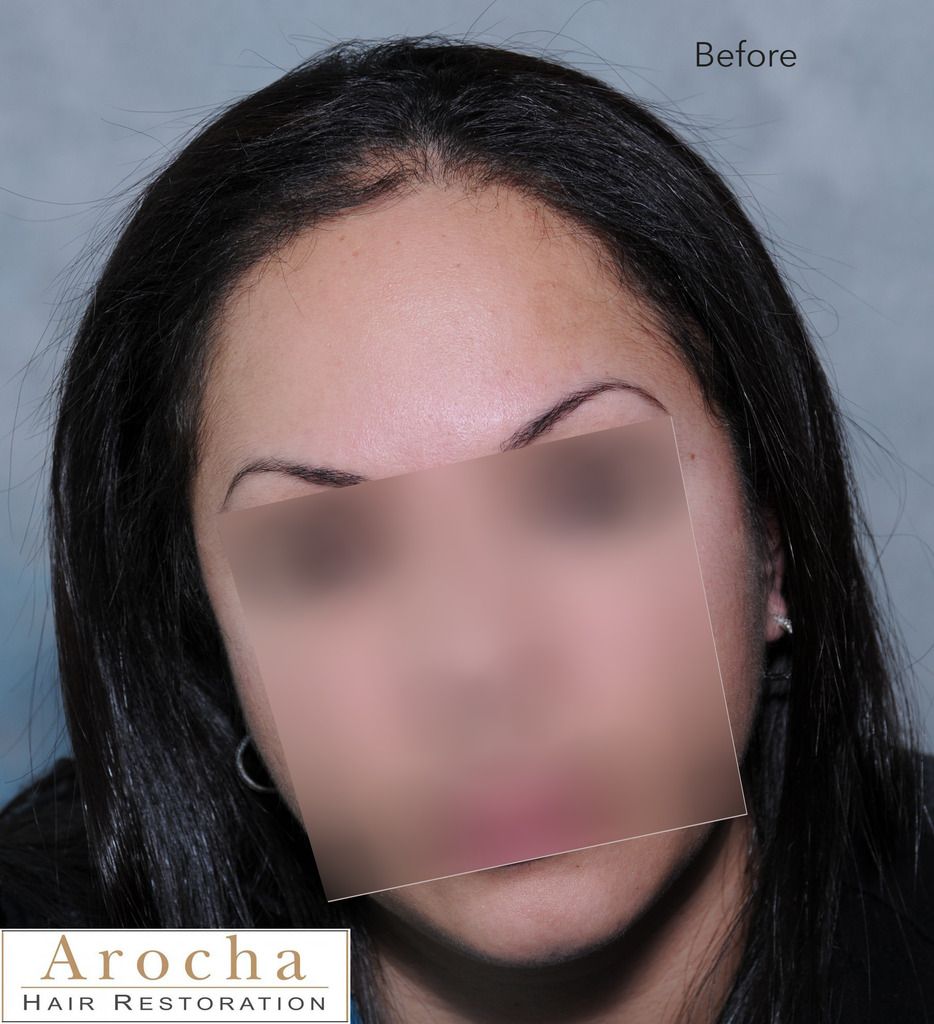 traction-alopecia-texas-1_zpsttcrb9zx.jpg