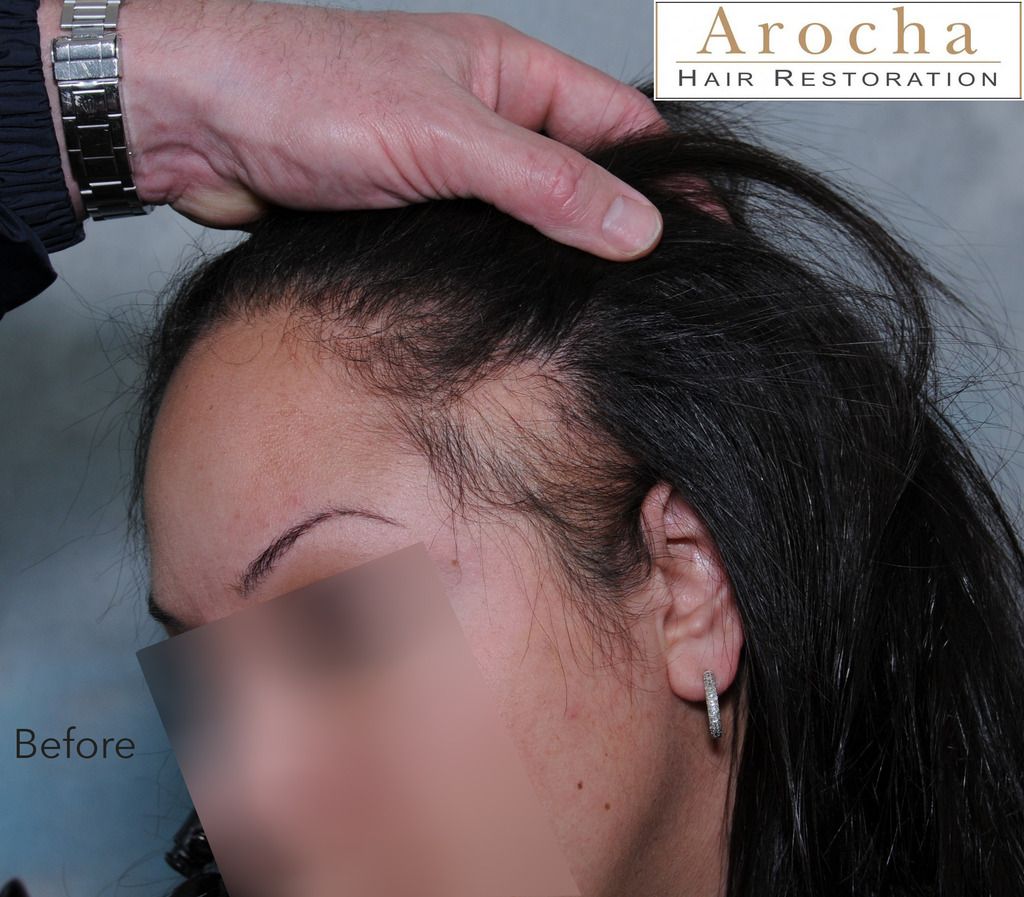 traction-alopecia-texas-2_zpsiugwnyxl.jpg
