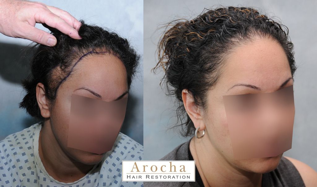 traction-alopecia-texas-3_zpsuuh0pffx.jpg