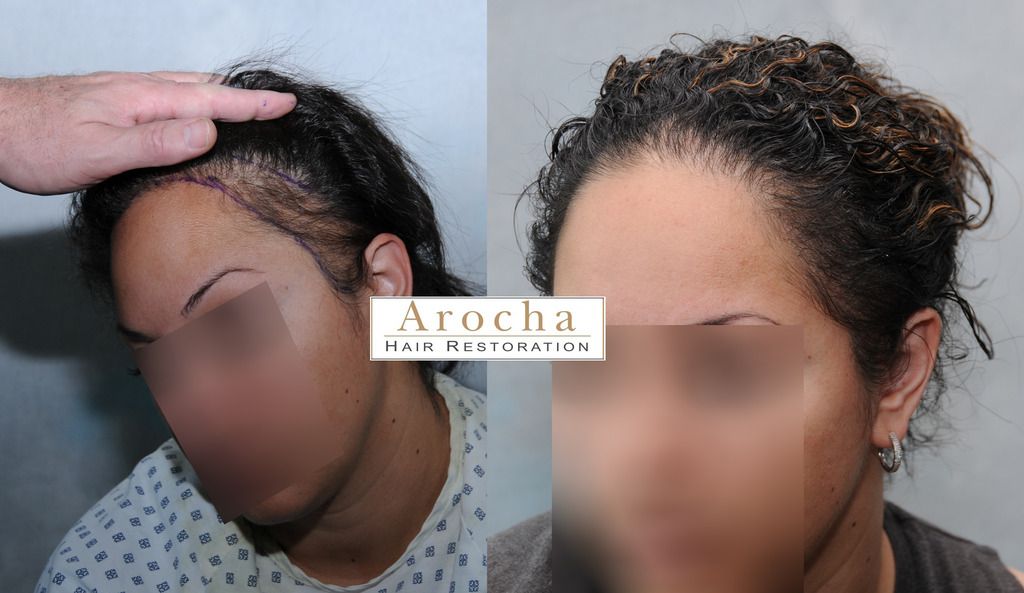 traction-alopecia-texas-4_zpshik29g0w.jpg