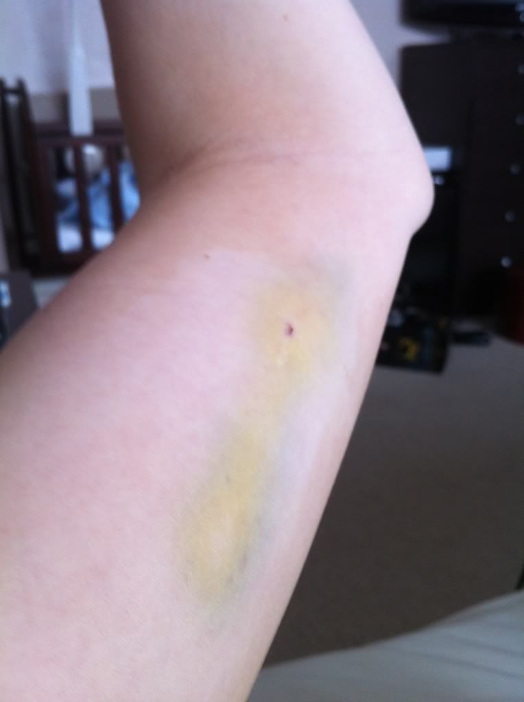 Huge implant bruise!! pic BabyCentre